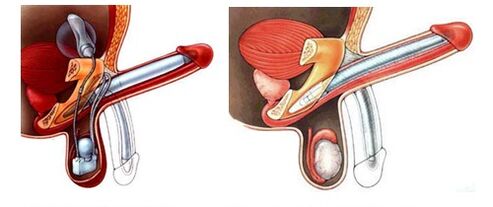 Penisprothese met opblaasbare prothese (links) en kunststof (rechts)