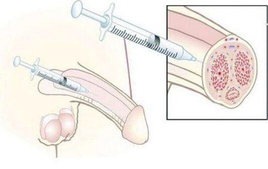 Injectie met hyaluronzuurinjecties