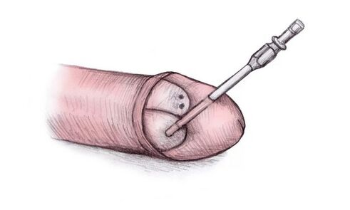 De kop van de penis kan worden vergroot door er hyalurongel in te injecteren