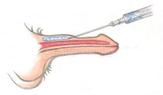 Volumizing hyaluronzuur injectie in de penis